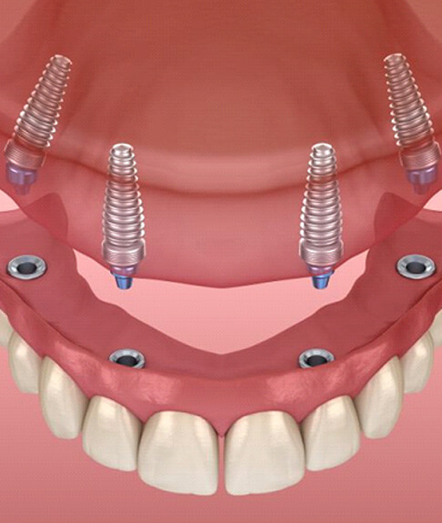 illustration of implant dentures for upper arch viewed from above