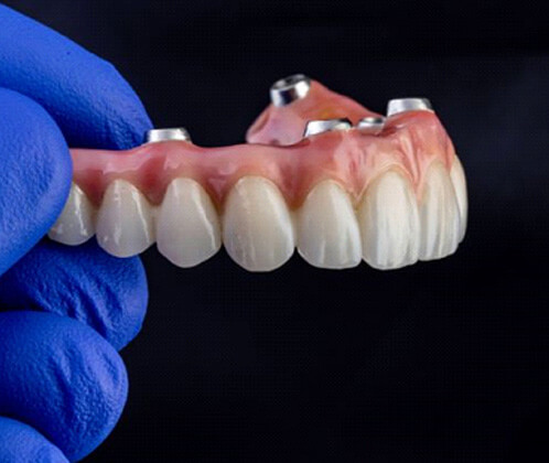 close-up of gloved hand holding implant denture