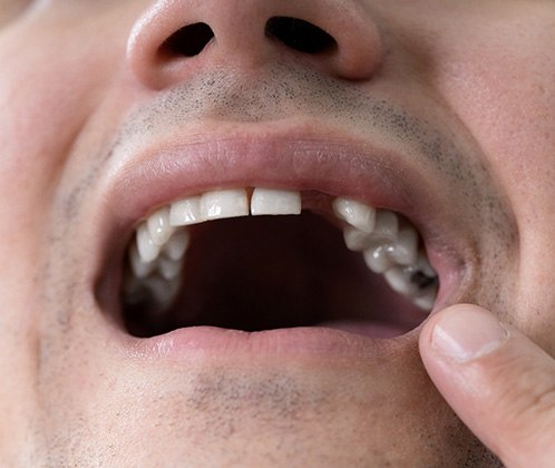 Man with a missing tooth