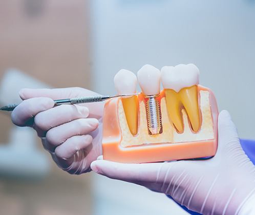 Dentist pointing to a dental implant model