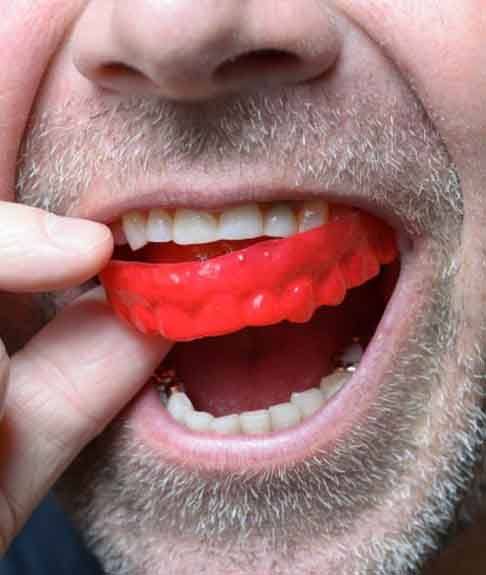 a man wearing a mouthguard to protect his dental implants