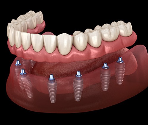 3D graphic of implant denture