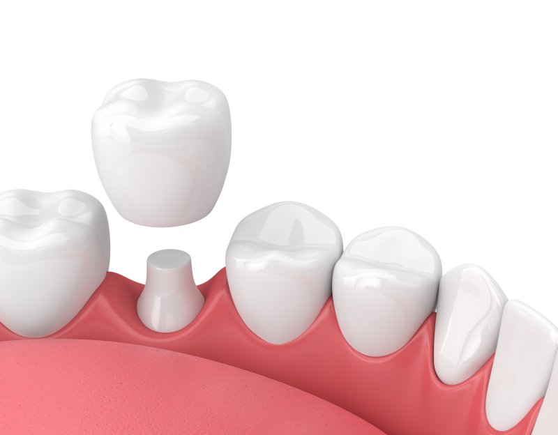 an illustration of a dental crown in Lakewood